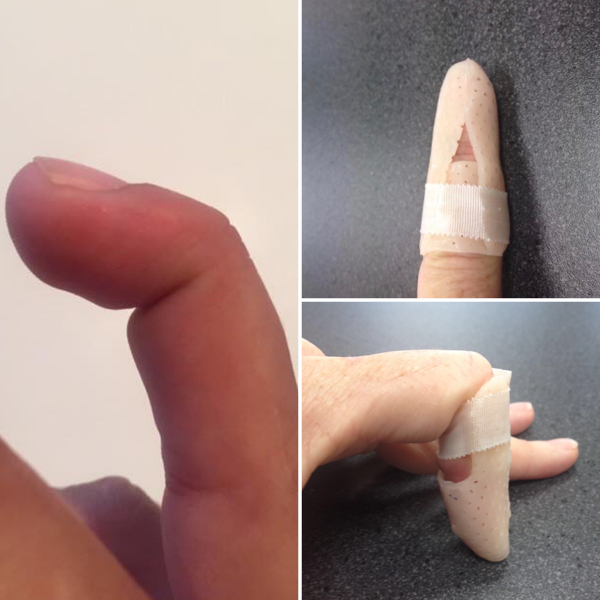 Fingertip Won't Straighten? It Could Be Mallet Finger